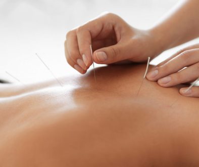 Young woman undergoing acupuncture treatment in salon, closeup